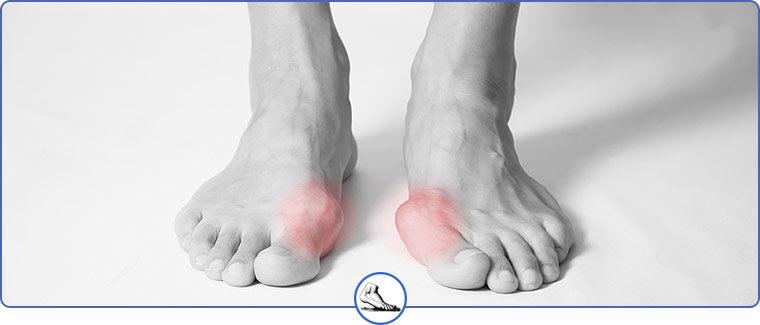 Bunion Specialist and Doctor Near Me in Walnut Creek CA and Brentwood CA Bunion Specialist and Doctor Near Me in Walnut Creek CA and Brentwood CA