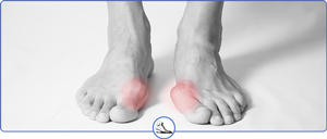 Bunion Specialist and Doctor Near Me in Walnut Creek CA and Brentwood CA Bunion Specialist and Doctor Near Me in Walnut Creek CA and Brentwood CA