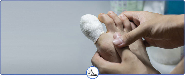 Fractured Toe vs Broken Toe Treatment Near Me in Walnut Creek CA - Bay Area Foot and Ankle