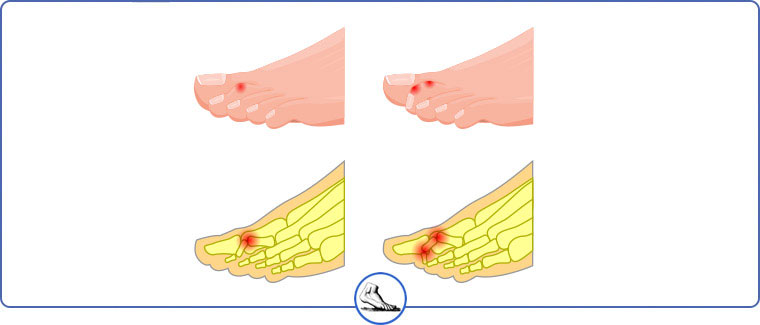 Hammertoe Specialist Near Me in Walnut Creek CA - Bay Area Foot and Ankle