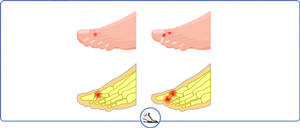 Hammertoe Specialist Near Me in Walnut Creek CA - Bay Area Foot and Ankle