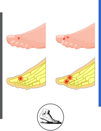 Hammertoe Treatment Near Me in Walnut Creek CA - Bay Area Foot and Ankle