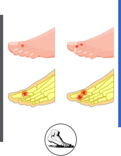 Hammertoe Treatment Near Me in Walnut Creek CA - Bay Area Foot and Ankle