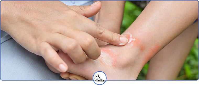 Foot and Ankle Insect Bite Treatment Near Me