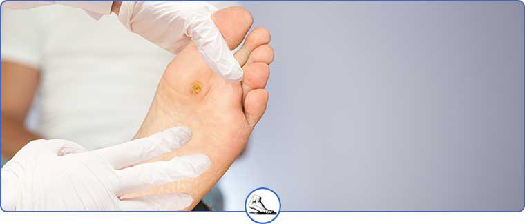 Plantar Warts Treatment Near Me in Walnut Creek, CA and Brentwood, CA