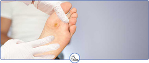 Plantar Warts Treatment Near Me in Walnut Creek, CA and Brentwood, CA