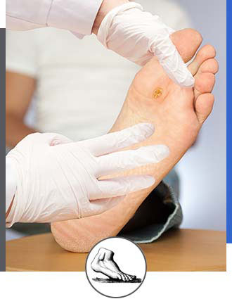 Warts Treatment Near Me in Walnut Creek CA - Bay Area Foot and Ankle