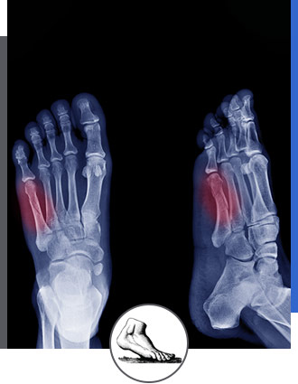 Foot and Ankle Fractures Specialist Near Me in Walnut Creek CA - Bay Area Foot and Ankle