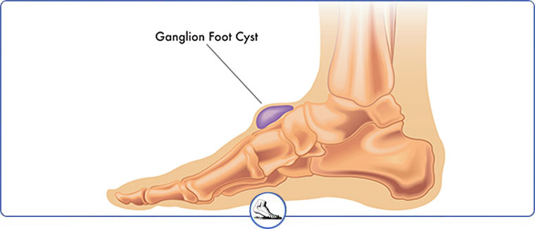 Foot and Ankle Ganglion Cysts Treatment Near Me in Brentwood & Walnut Creek, CA