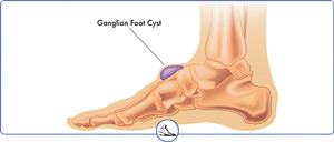 Foot and Ankle Ganglion Cysts Treatment Near Me in Brentwood & Walnut Creek, CA