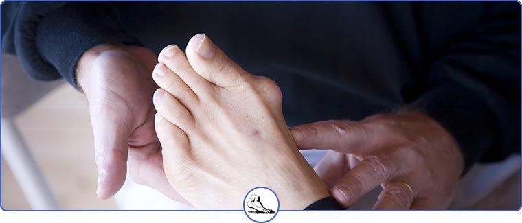 Bunion Treatment Specialist Near Me in Walnut Creek and Brentwood CA