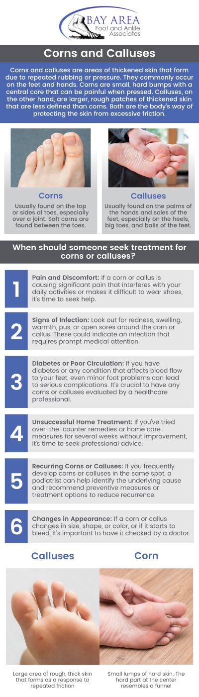 Corns and calluses develop from repeated pressure or friction, often caused by tight shoes or irregular foot mechanics. Treatment focuses on easing discomfort and safely removing the thickened skin. Dr. John W. Scivally, DPM, and Dr. Robin K. Lie, DPM can accurately diagnose the cause, provide safe removal, and recommend customized solutions like orthotics or footwear adjustments to prevent the issue from returning. Visit Bay Area Foot and Ankle Associates for professional care. For more information, contact us or book an appointment online. We have convenient locations to serve you in Walnut Creek, CA and Brentwood, CA.